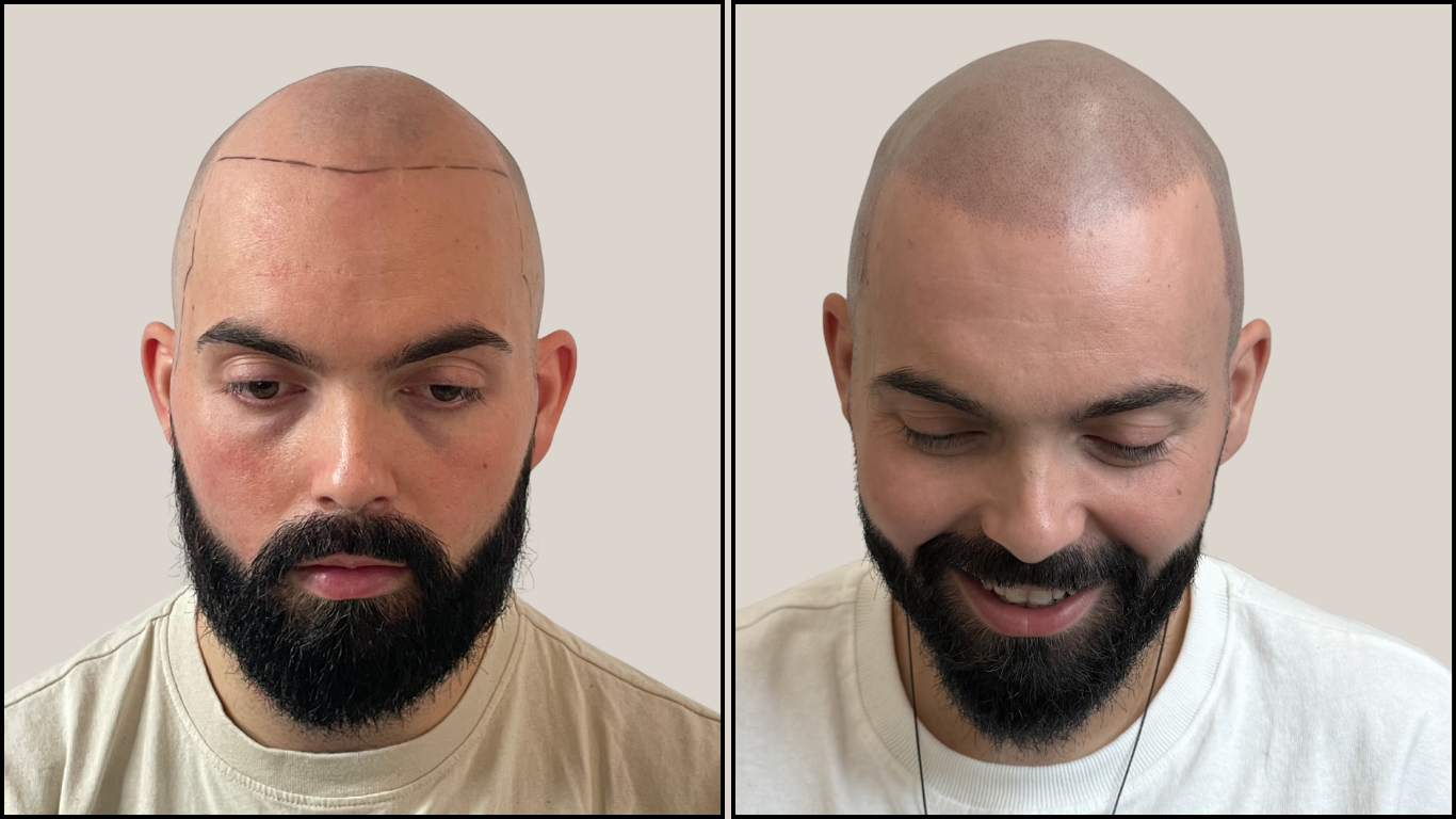 Avant / Après