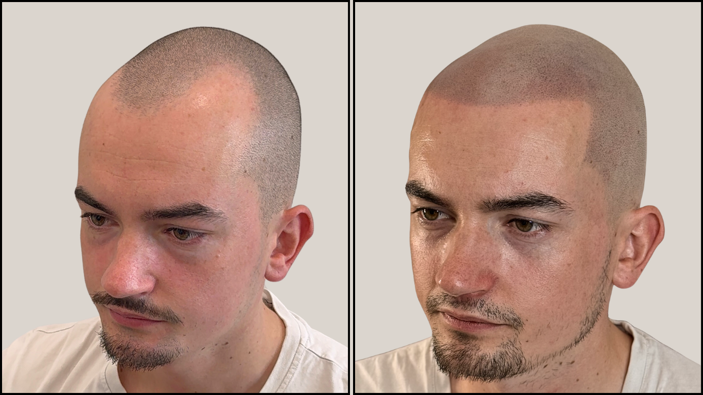 Avant / Après