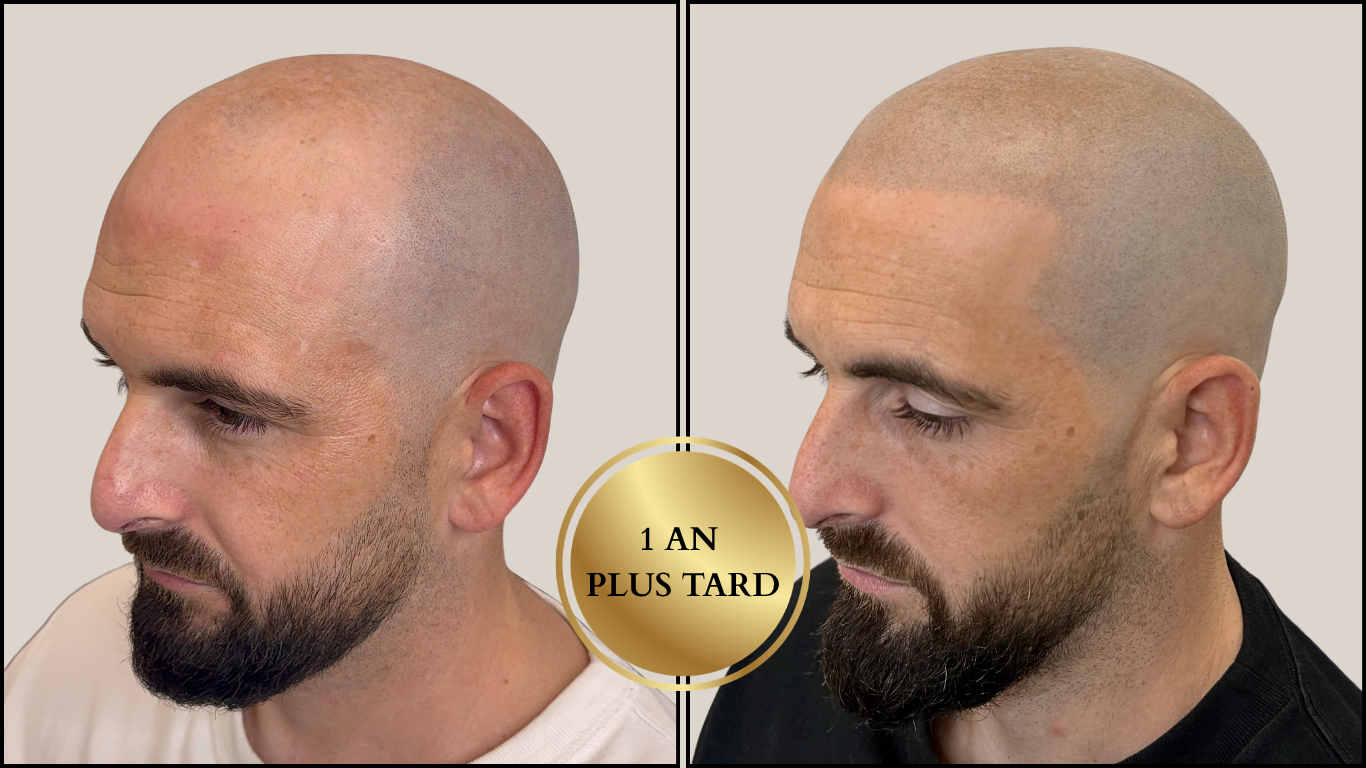 Avant / Après