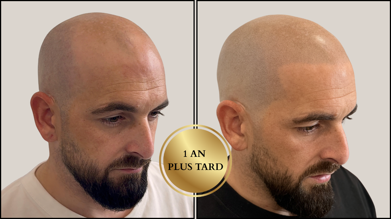 Avant / Après