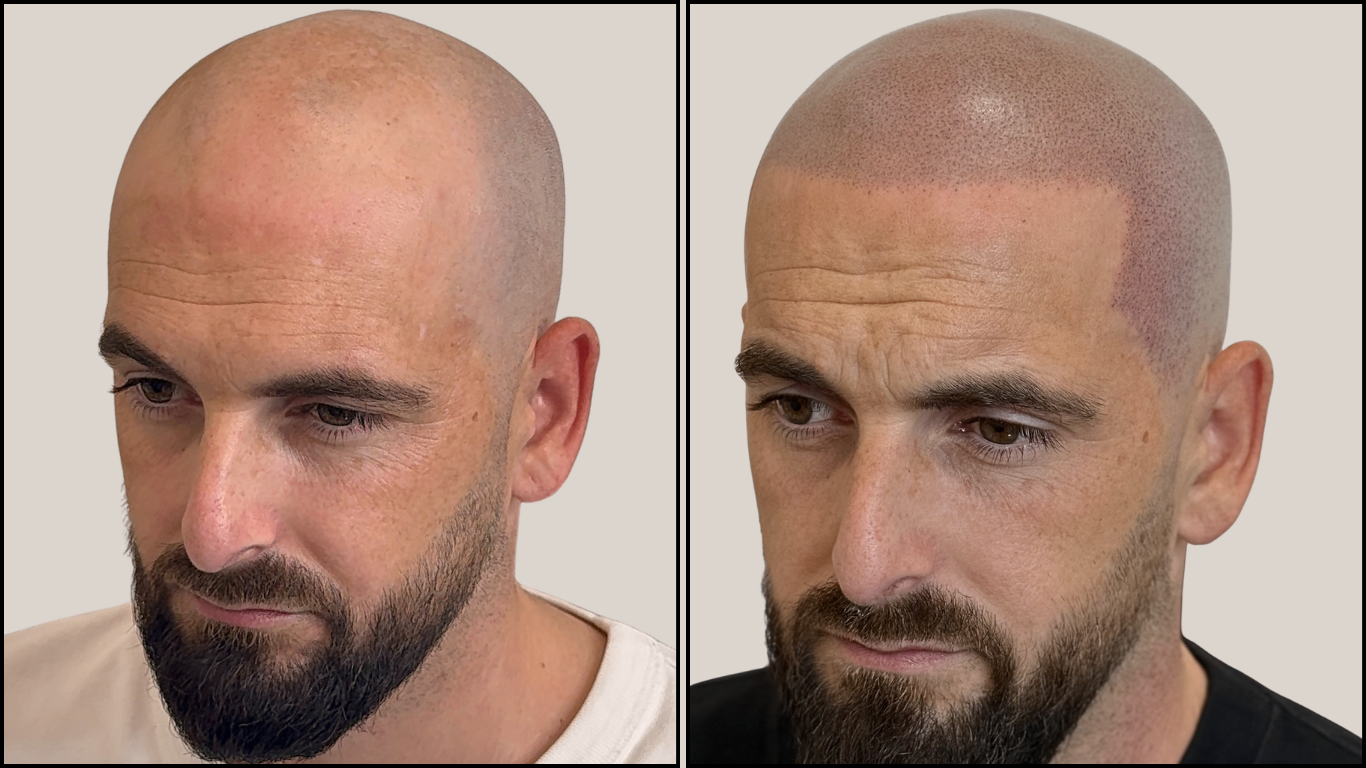 Avant / Après