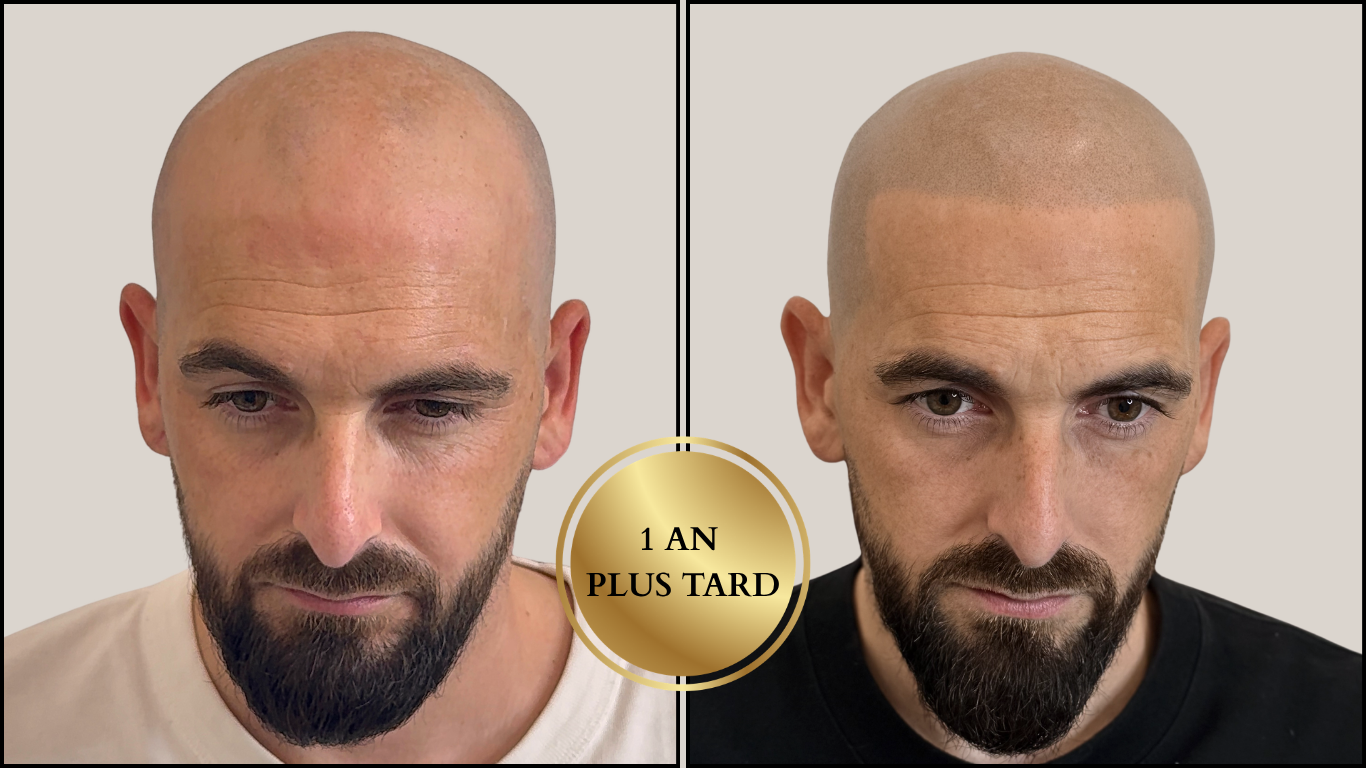 Avant / Après